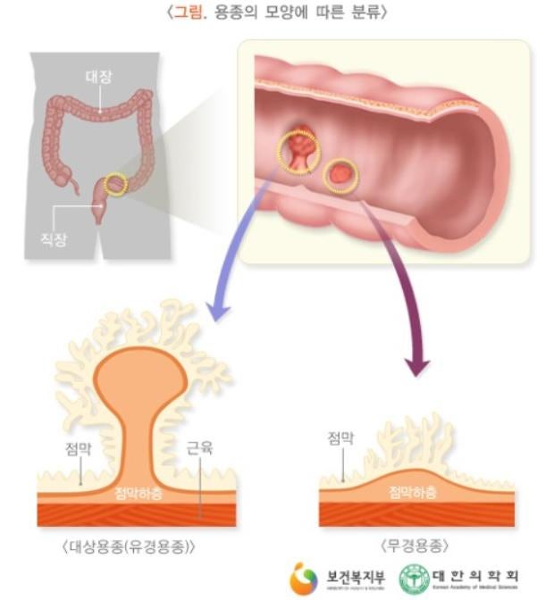 용종을 제거했습니다. 보험금 받을 수 있을까요?