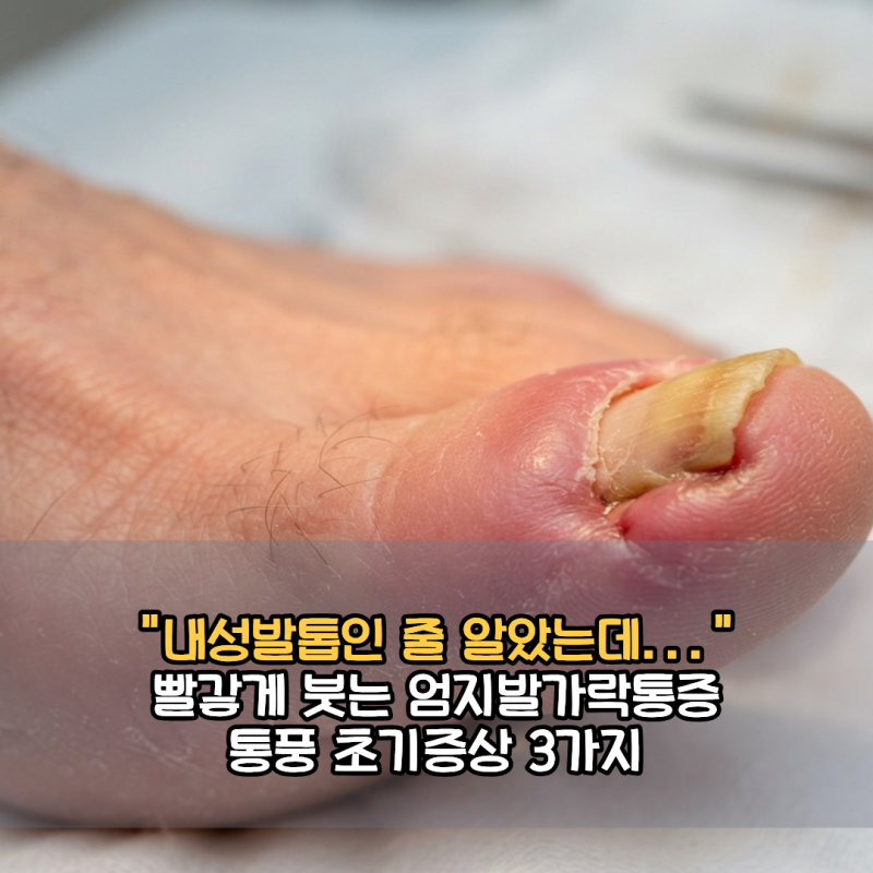 "내성발톱인 줄 알았는데.." 빨갛게 붓는 엄지발가락통증 통풍 초기증상 3가지