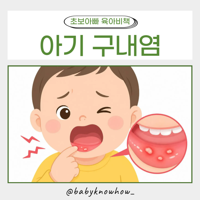 아기 구내염 관리해 보니 중요했던 4가지