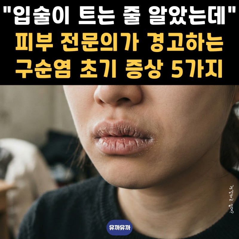 "그냥 입술이 트는 줄 알았는데" 피부 전문의가 경고하는 구순염 초기 증상 5가지