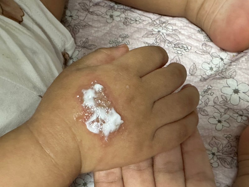 아기 데일밴드 부작용 접촉성 피부염 초기 증상부터 연고 처방 원인 대처 관리방법 후기