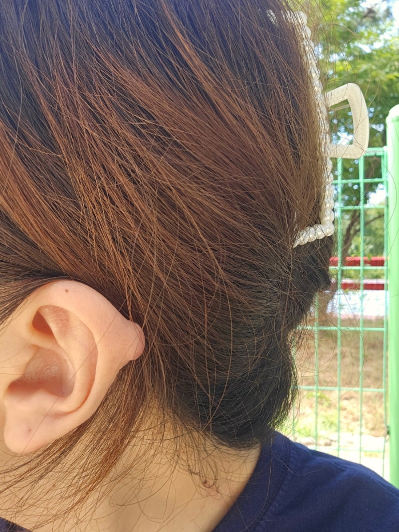 귀 피어싱 켈로이드 수술 (일반외과) 후기. 기록용.