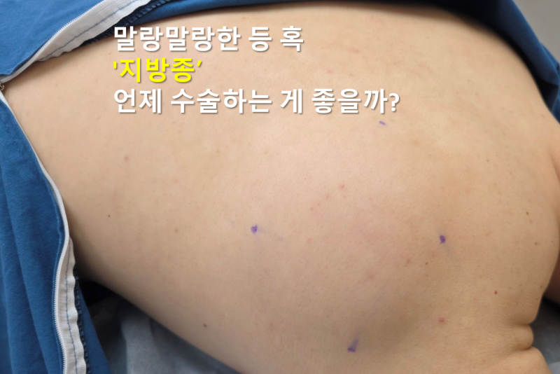 등 지방종이 생겼을 때 대처 방법