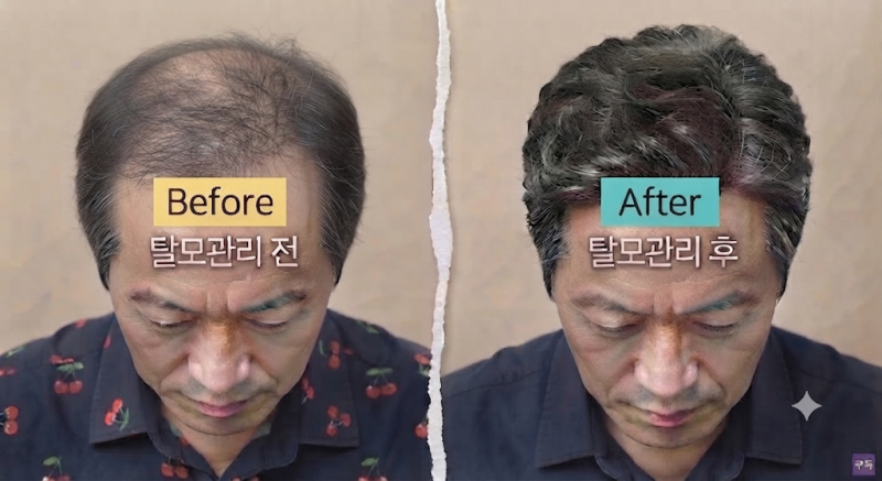 [꿀정보] 탈모로 고생하시는 분...지금 당장 다이소 가세요!"다이소 5000원짜리로 탈모 끝?