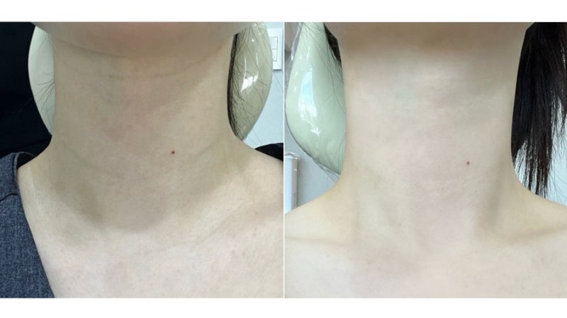 목주름 시술 관리 정보 (1년 6개월 후기 경과, 가격, 벨로테로 필러 쥬베룩 다운타임)