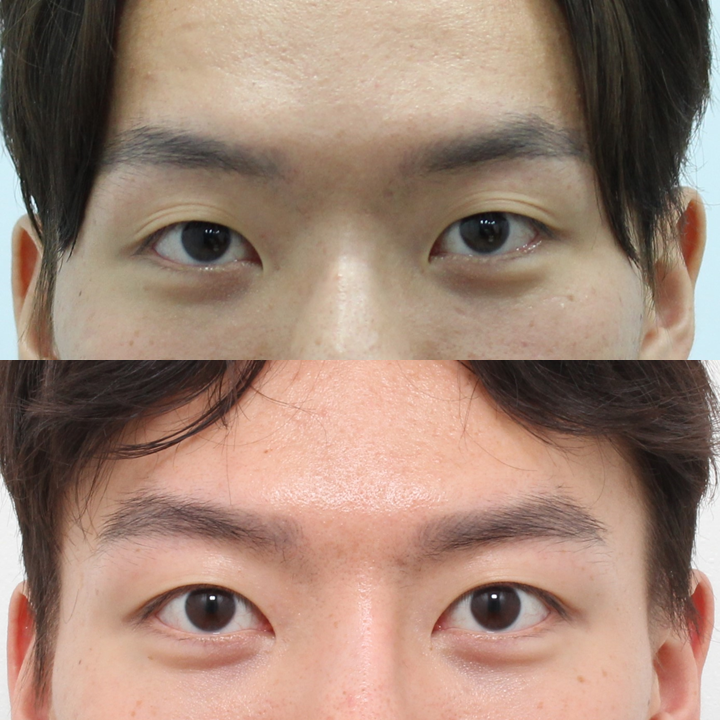 남자 비절개 쌍꺼풀과 눈매교정, 자연스러운 속쌍꺼풀을 원한다면