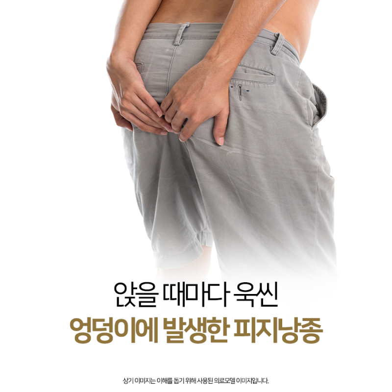 유독 불편하게 다가오는 부산서면엉덩이피지낭종, 제거를 하고자 하신다면