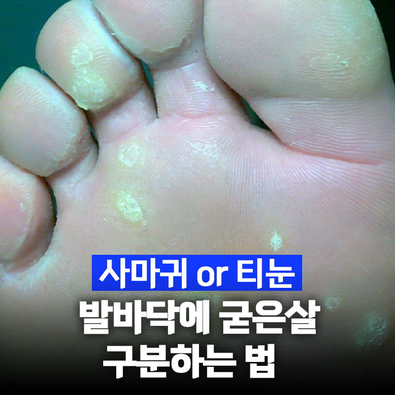 발바닥 사마귀 냉동치료 통증과 횟수 얼마나 걸릴까?