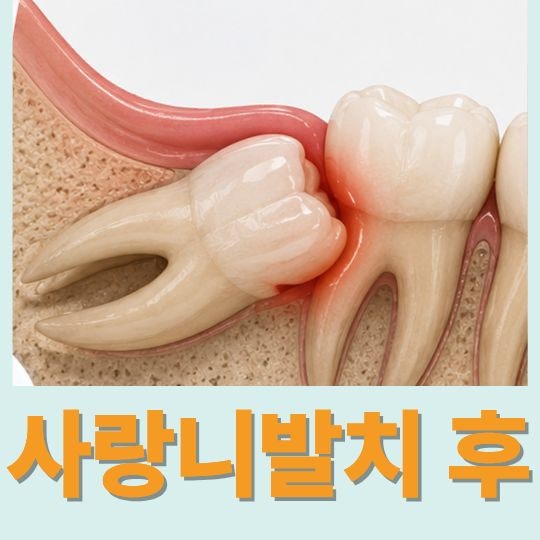 돈암동치과 사랑니 발치 후 붓기 통증 식사 양치질