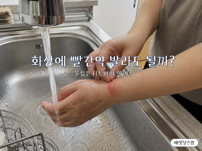 화상에 빨간약 발라도 될까? 물집 생겼을 때 먼저 해야 할 일