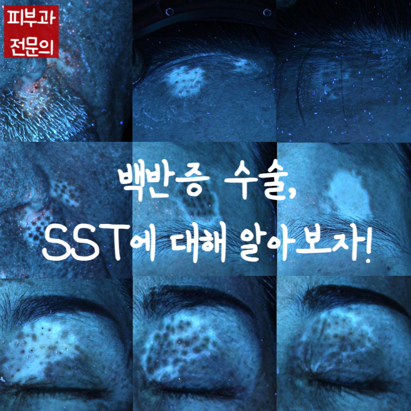 백반증수술:SST(Skin Seeding Technique/미세펀치이식술)의 원리, 효과, 치료성공률, 추천되는 경우....