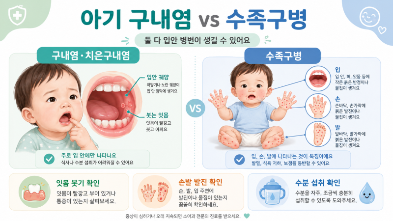 아기 구내염 수족구 차이, 손발 발진보다 먼저 확인할 5가지