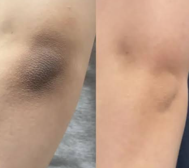 흑꿈치 겨드랑이 착색 색소침착 해결 아이템 추천 비교분석