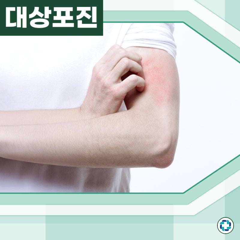 대상포진 잠복기 증상, 싱그릭스 사백신으로 예방