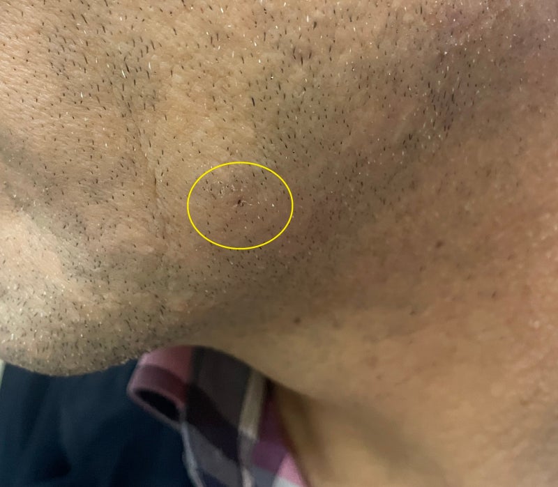 표피낭 병원 추천 재발 없이 제거하려면 이것부터 확인하세요