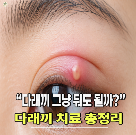 "눈꺼풀에 콩알이 잡혔다면?" 다래끼 치료방법·치료비용까지 알아봤어요