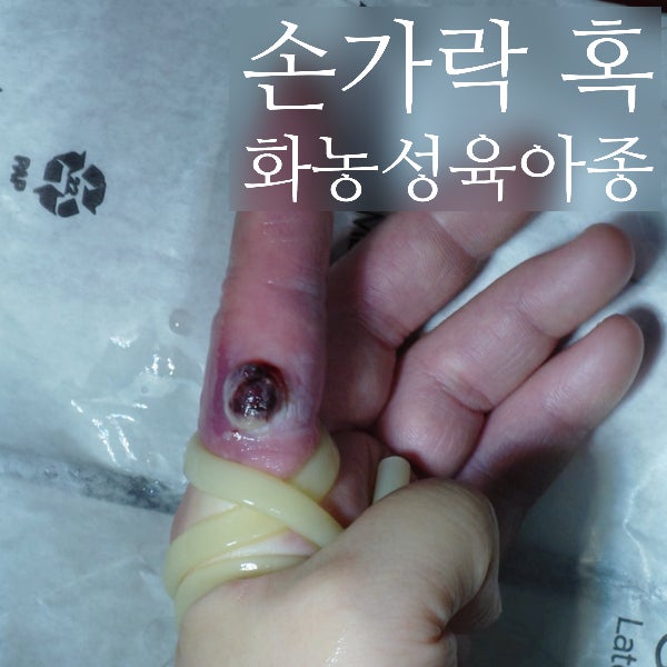[손가락 혹] 갑자기 자란 빨간 혹, 피 잘 나는 '화농성 육아종' 원인과 치료법