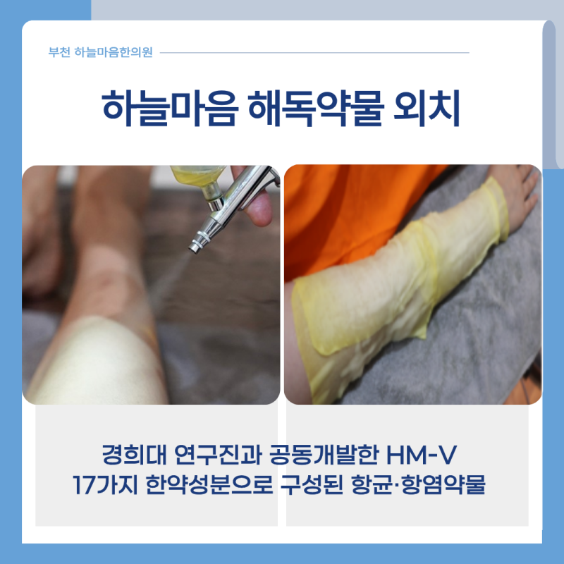 부천 동전습진, 동그란 습진이 자꾸 생기는 이유 — 화폐상 습진 원인과 한방 관리