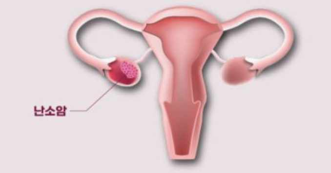 15. 난소암 수술방법과 치료과정 한눈에 보기