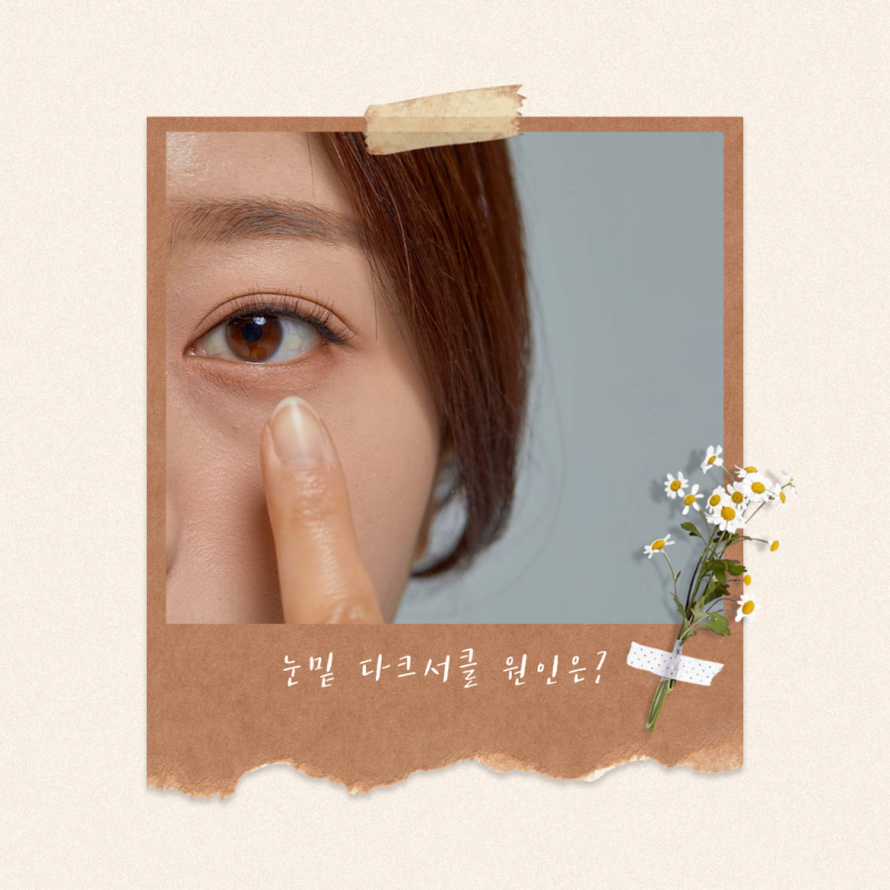 눈밑에 다크서클 유난히 짙은 이유는? 원인 및 관리법 총정리