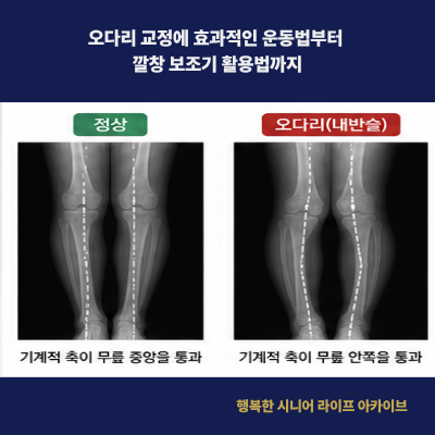 오다리 교정에 효과적인 운동법부터 깔창 보조기 활용법까지
