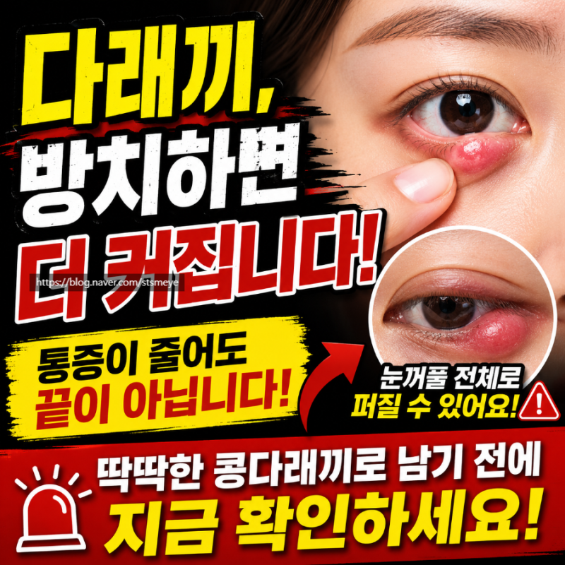 경기 송탄성모안과 : 다래끼 방치하면 안 되는 이유, 통증 없어져도 콩다래끼로 남을 수 있어....