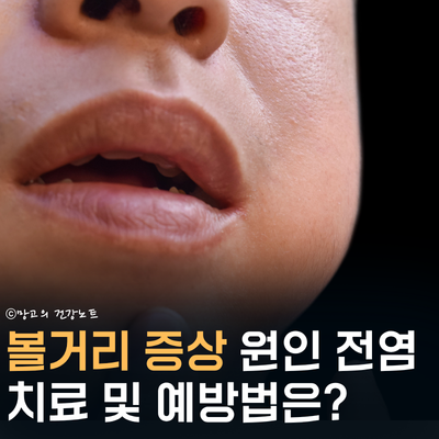 볼거리 증상 원인 전염 격리기간 치료 예방법은?