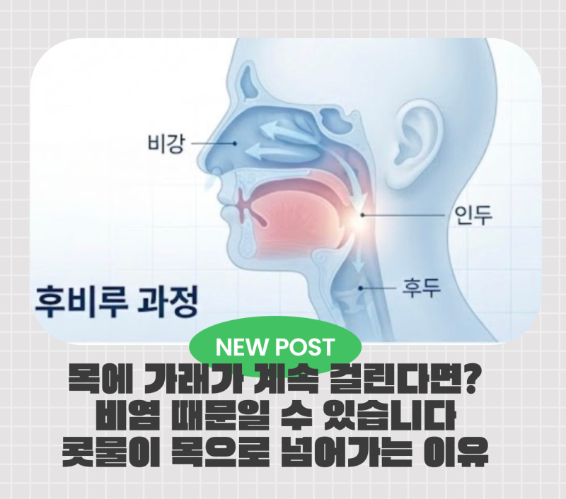 비염 후비루 때문에 기침이 멈추지 않는다면? 원인과 치료 방법 알아보기