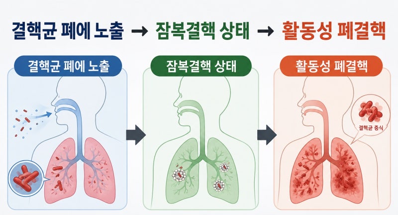 잠복결핵 치료해야 하나요?