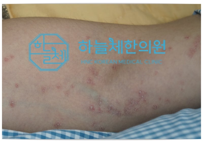 대전건선 연고 사용과 두피 손발톱의 변화까지 다시 살펴봐야