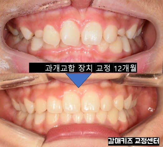 갈매 과개교합 교정 치과 / 액티베이터 교정과 프리올소 교정 (키즈앤주니어치과)