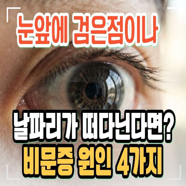 눈앞에 검은점이 떠다니는 비문증 원인 4가지와 자연치유 가능할까?