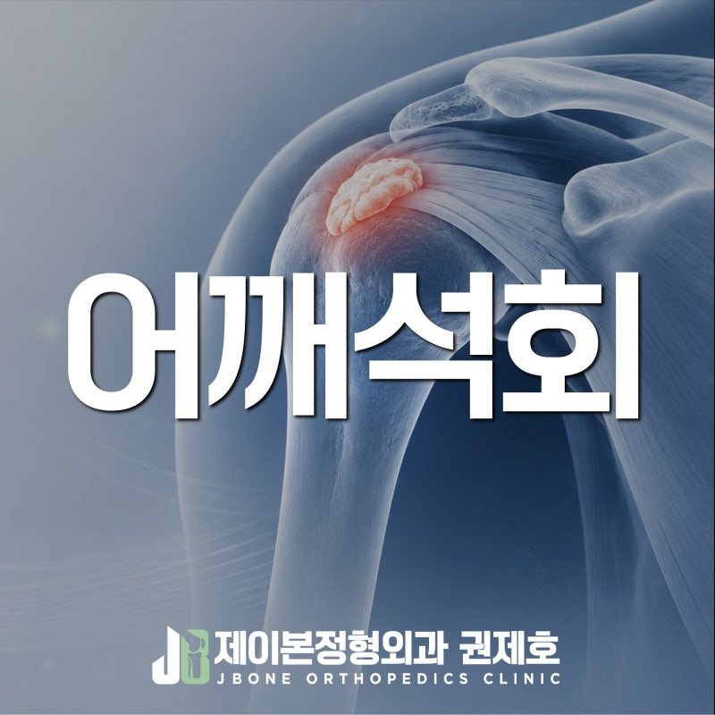 어깨 석회, 충격파에도 낫지 않아 관절경으로 제거한 50대 여성