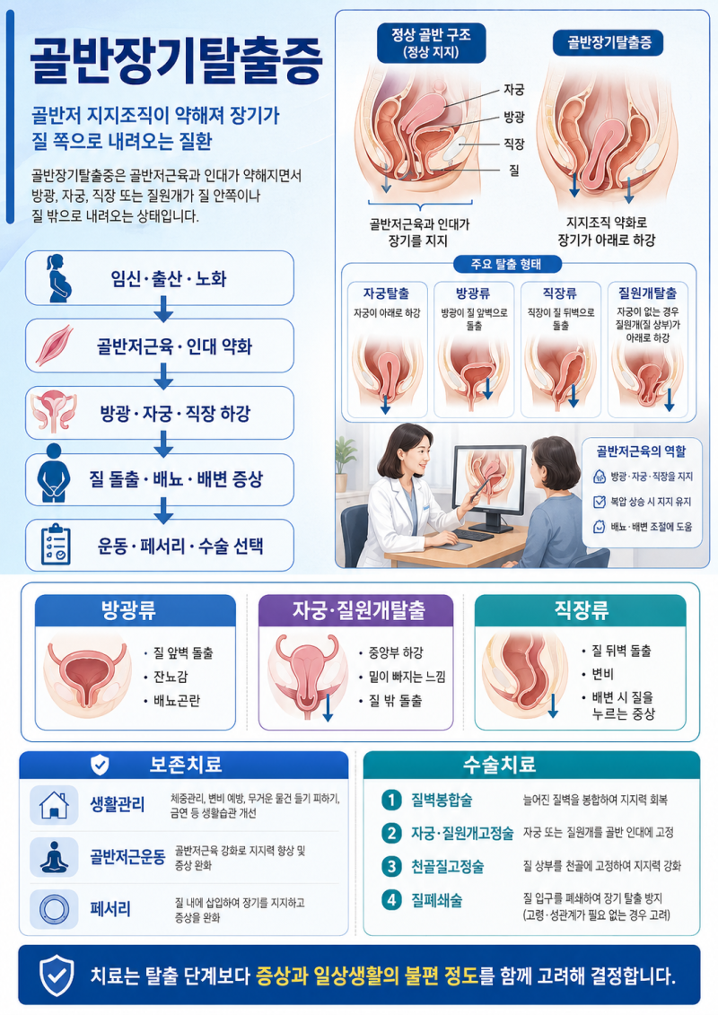 골반장기탈출증, 골반 장기를 지지하는 조직이 약해져 방광·자궁·직장 등이 질 쪽으로 내려....