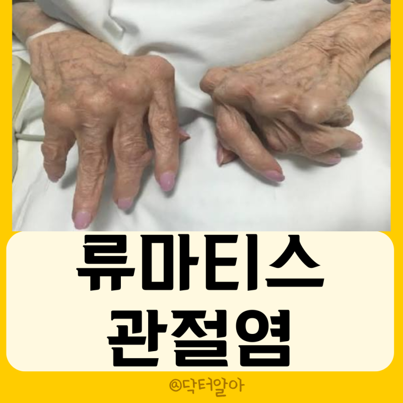 의사가 설명하는 류마티스관절염 정의 증상 원인 진단 치료 예방