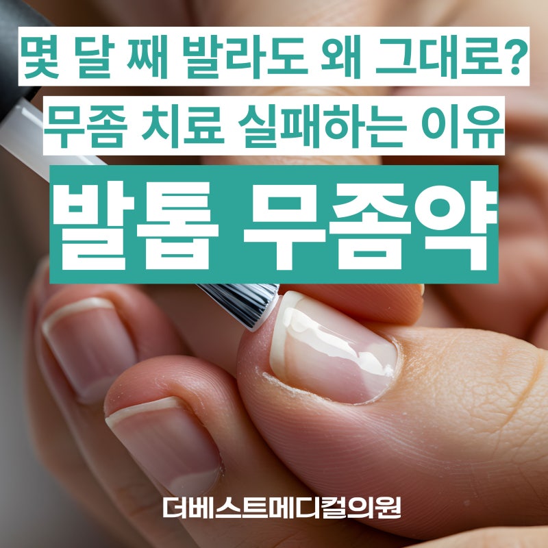발톱 무좀, 약만 바르면 낫는다고요? 많은 분들이 치료에 실패하는 이유