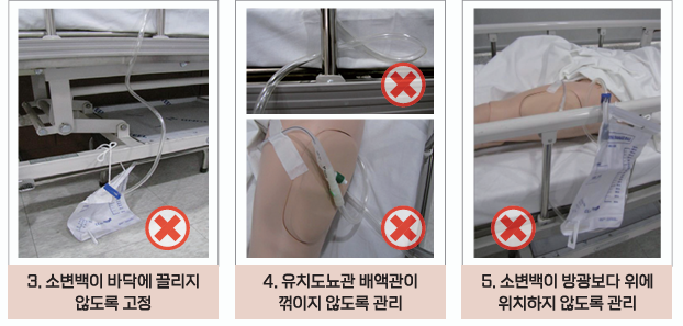 요양보호사가 반드시 알아야 하는 유치도뇨관 관리법! 감염 예방과 올바른 소변백 관리