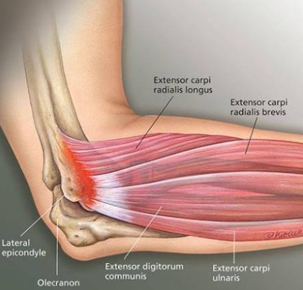 테니스엘보우(ECRB)재활 프로토콜(extensor carpi radialis brevis)rehab. protocol