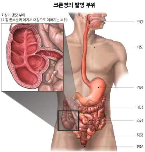 '완치 어려운 크론병' 새로운 치료 가능성 열렸다…DNA 분석으로 핵심 유전자 100개 발견