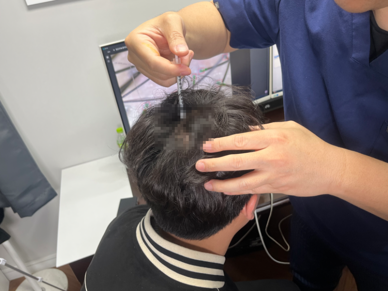 원형 탈모치료 병원 방문 전 꼭 확인해야 할 '이것'