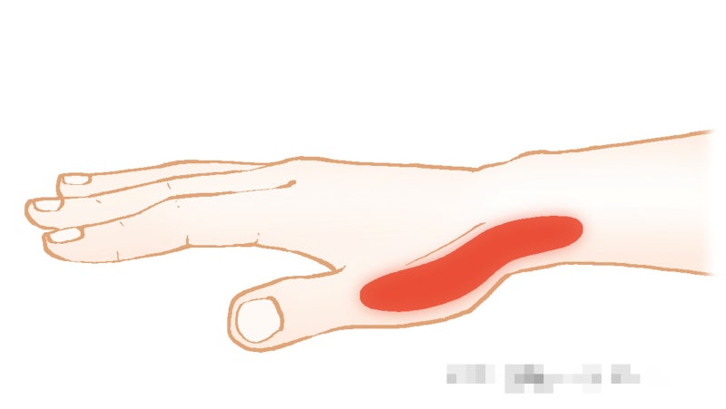 엄지손가락 손목통증, 손목건초염 드퀘르벵 증상 및 치료