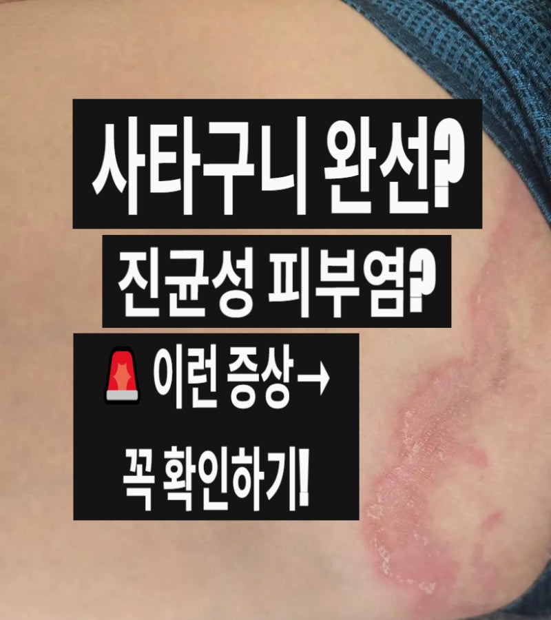 진균성 피부염 증상과 치료 총정리! 연고·전염·사타구니 완선까지