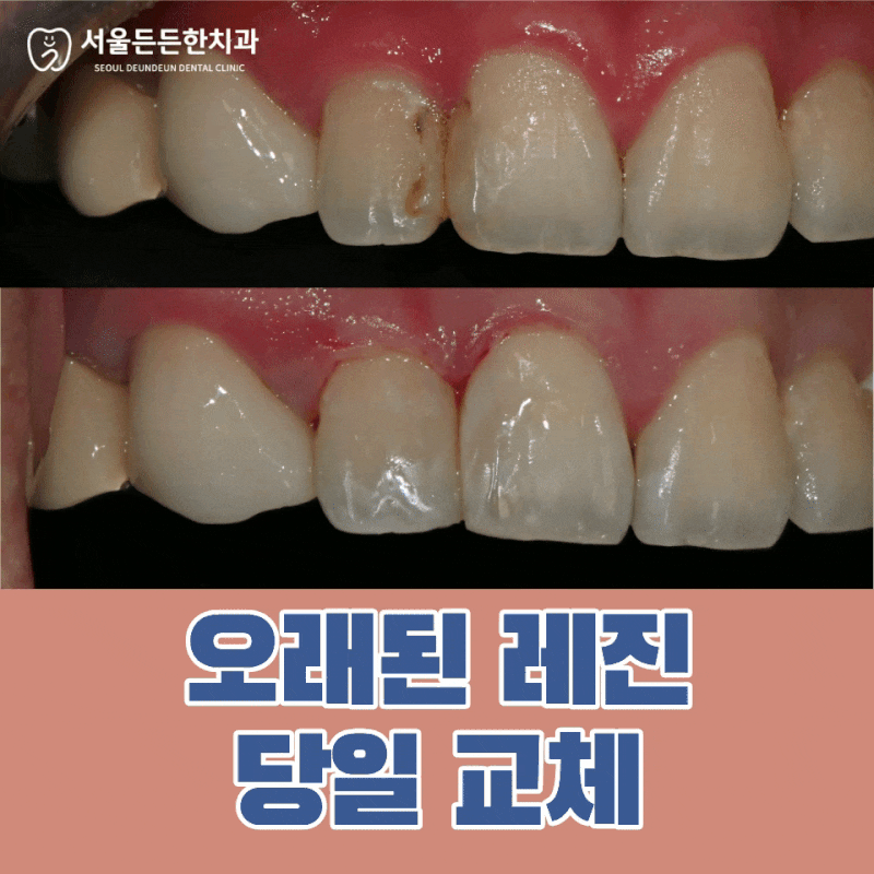 오래된 레진, 주변에 충치가 생긴 것 같은데 교체 되나요? - 군자역 치과 당일 앞니 레진 치료....