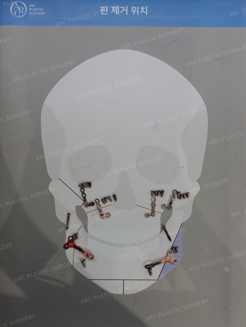 10년 넘은 양악수술 핀제거 가능할까?