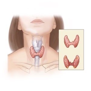 갑상선 검사, 왜 난임 검사에 포함되나요? - 난임과 갑상선 검사