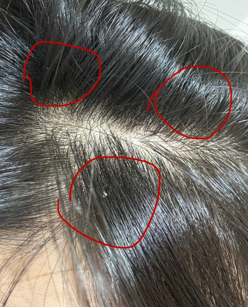 임산부 두피 각질 해결법 / 두피 각질 추천 샴푸 내돈내산 광고 ❌ 청미정다시마샴푸