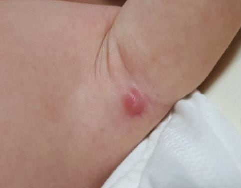 겨드랑이 혹 통증, 병원, 멍울, 아픔, 크기, 제거, 조직검사