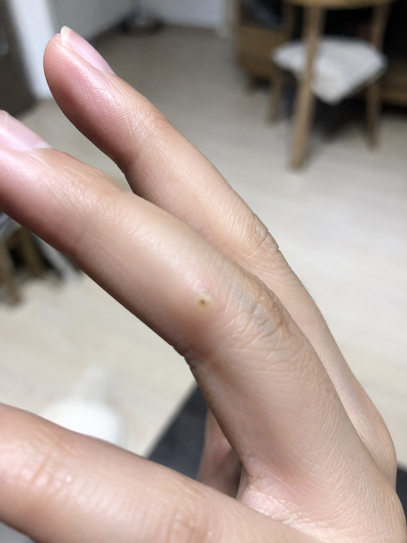 망원역 손가락 티눈제거 비용, 내과에서도 제거할 수 있다는 걸 알게 된 후기?