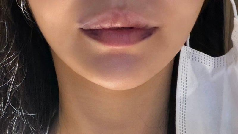 입술필러 녹이기 붓기, 멍, 통증, 가격