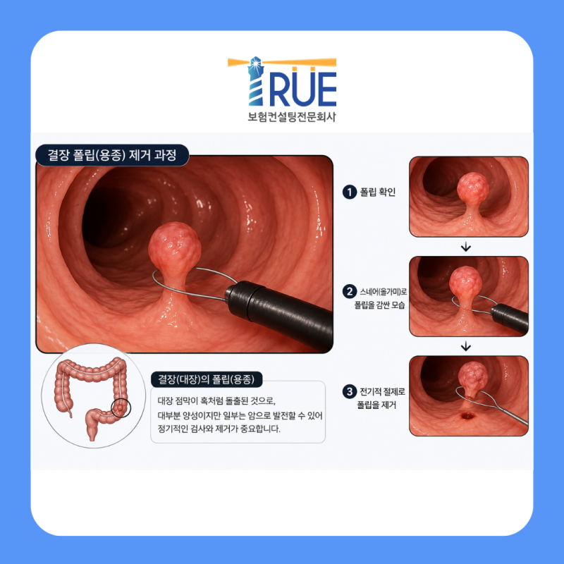 결장의 폴립(용종) 보험금 지급사례2